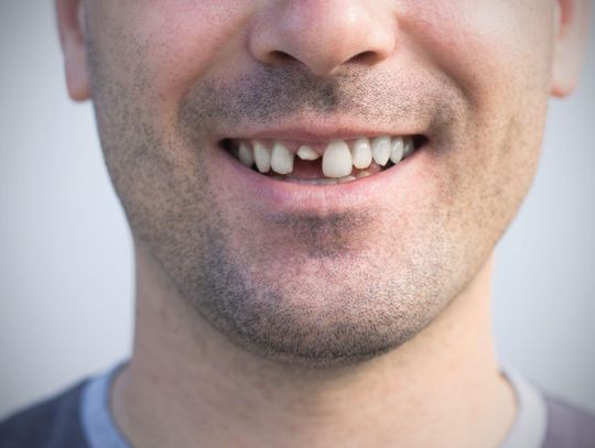 Implant jedynki – jak uratować uśmiech po utracie przedniego zęba?